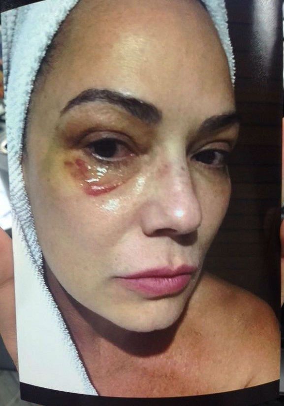 foto-de-luiza-brunet-com-hematoma-no-olho-direito
