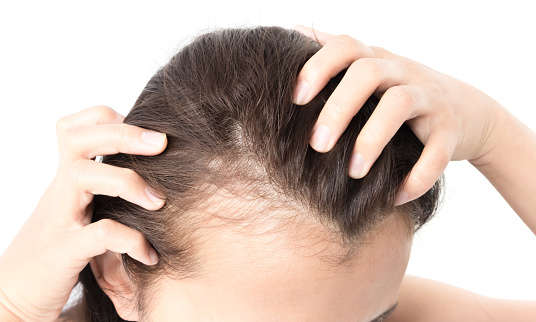 queda de cabelo – mulher