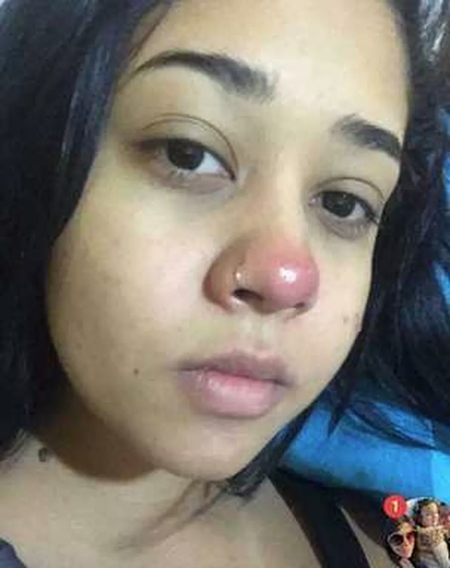 Infecção Infecção
