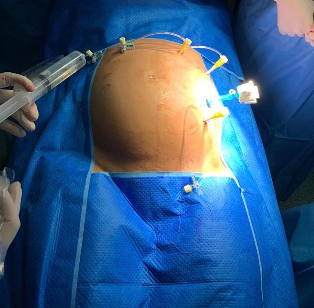 Cirurgia fetal 2 Cirurgia fetal 2