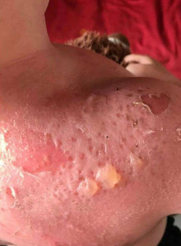 Pele do menino após sofrer as queimaduras Pele do menino após sofrer as queimaduras