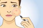 Acne da mulher adulta por que ocorre e como tratar