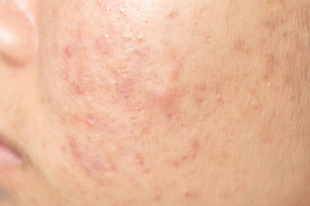 scar from acne
