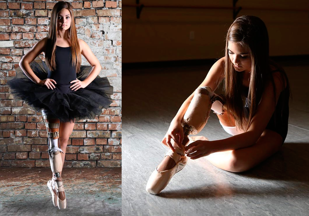 Ela teve que amputar uma perna, mas não desistiu de ser bailarina