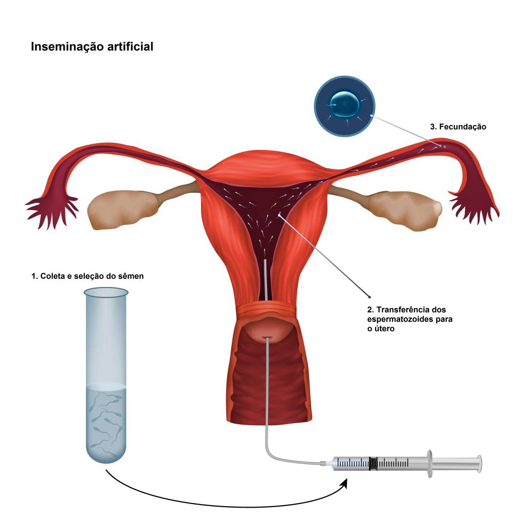 Inseminação artificial ilustração Artificial insemination, illustration