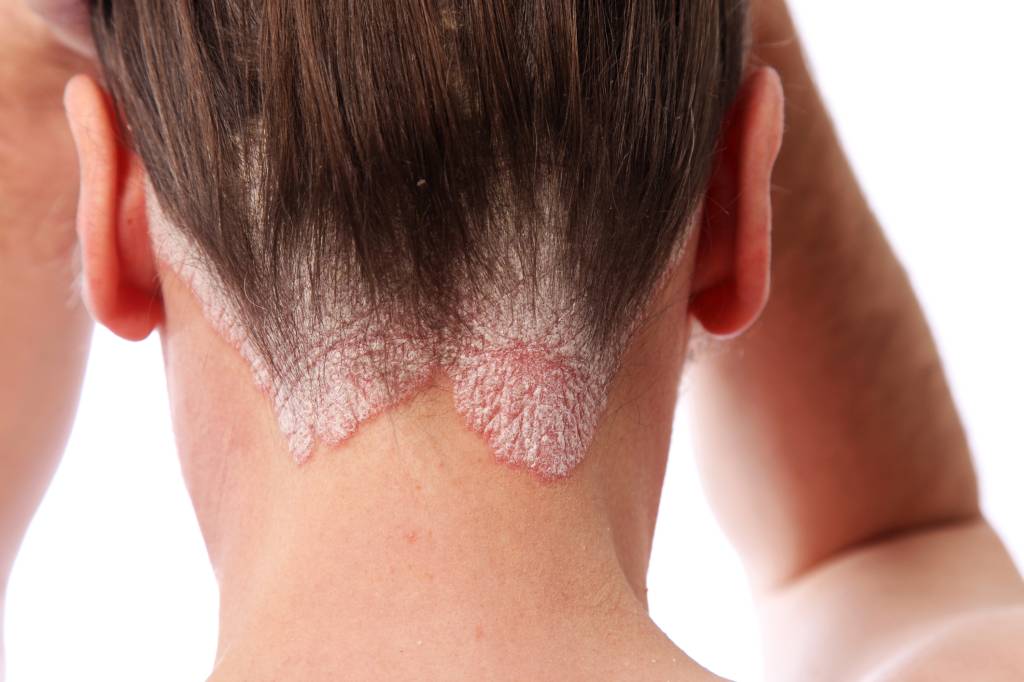 Lesões de psoríase schuppenflechte on the hairline and scalp