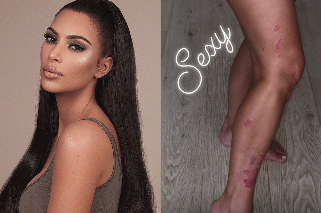 Saiba tudo sobre psoríase, a doença de pele de Kim Kardashian