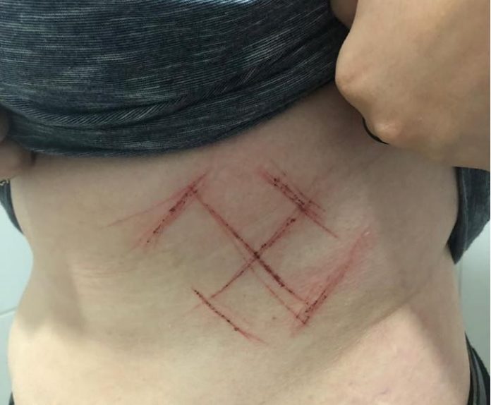Jovem contrária a Bolsonaro é agredida com socos e marcada com suástica