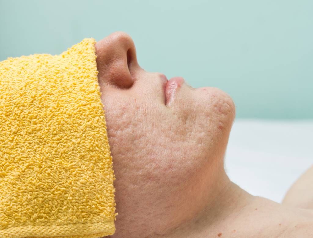 Saiba como amenizar ou até eliminar as cicatrizes causadas pela acne