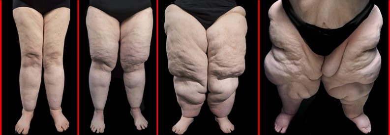 Lipedema estágios os quatro estágios do lipedema