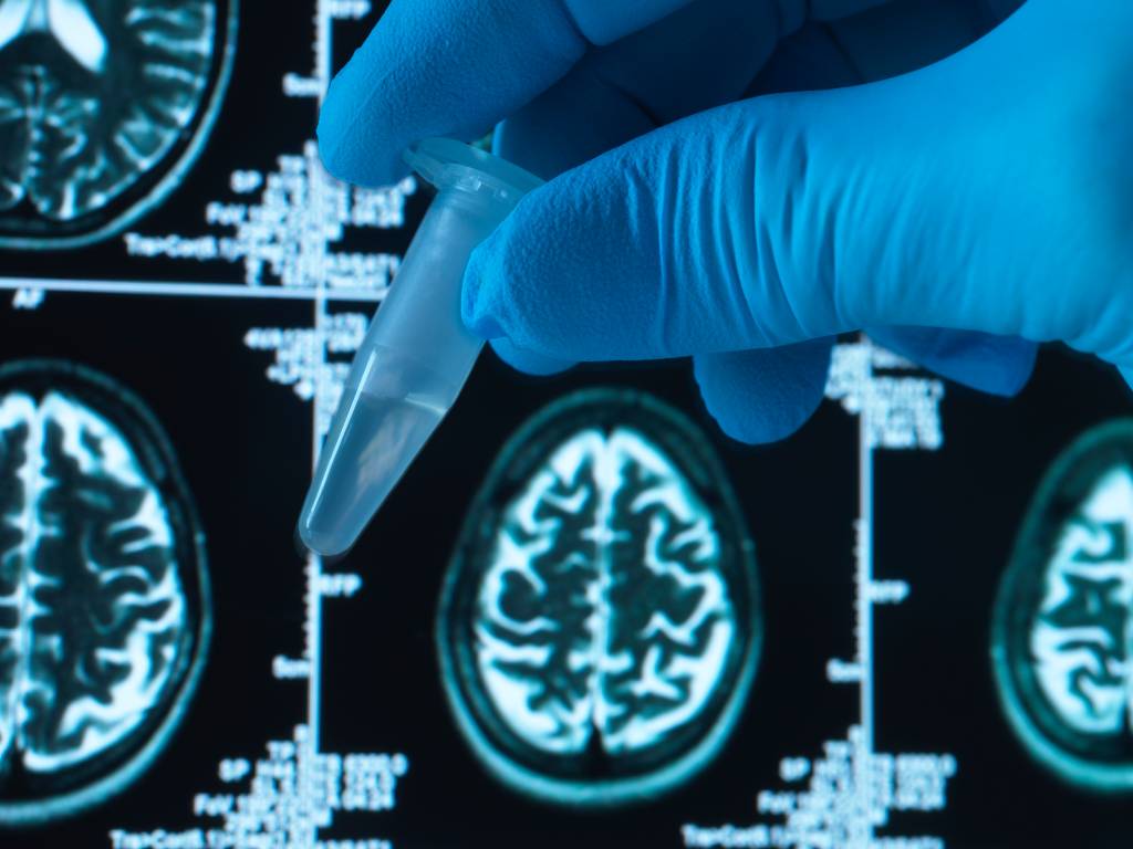 Cientistas encontram a causa do avanço do Alzheimer no cérebro