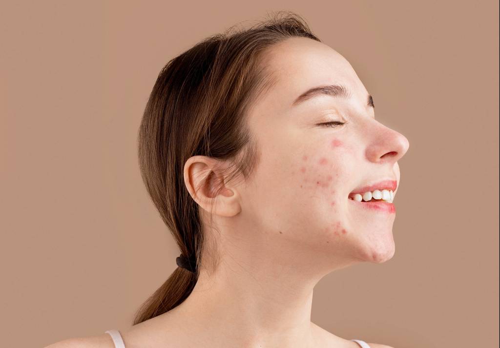 Conheça os principais tipos de acne