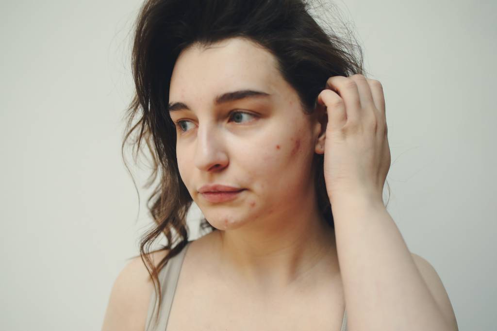 Acne Mulher com espinhas no rosto