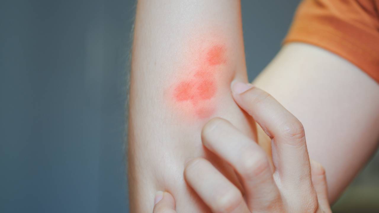 Esporotricose: o que é a doença que acendeu um alerta em infectologistas