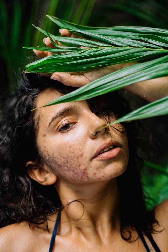 acnes-manchas-pele-ácido-azelaico-cuidados-skincare