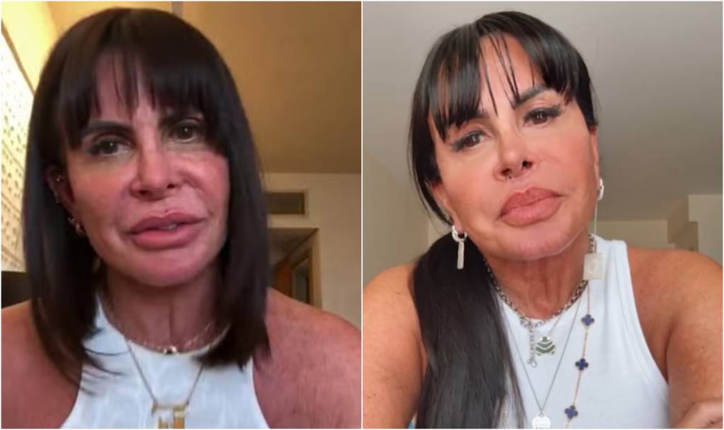 harmo-gretchen Gretchen já disse ser adepta a realizar harmonizações faciais há 5 anos