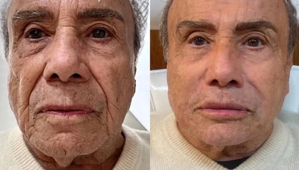 harmonizacao-stenio-garcia Aos 91 anos, o ator Stênio Garcia ganhou um novo visual com harmonização facial