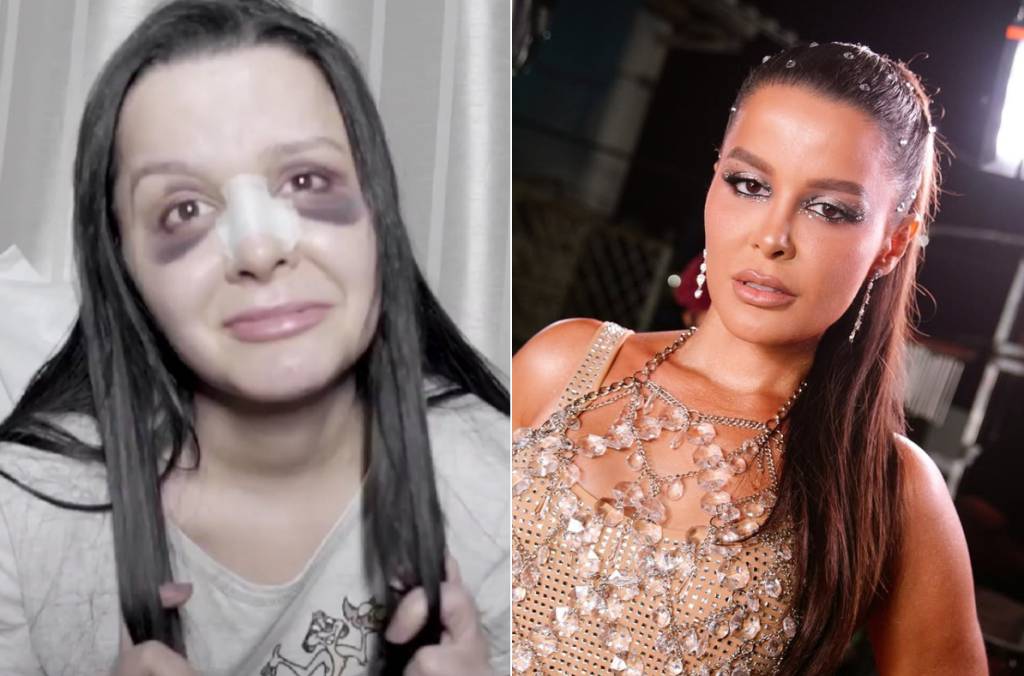 rinoplastia-antes-depois-maraisa (1) A cantora Maraísa mostrou os curativos no nariz após a cirurgia, há 5 anos
