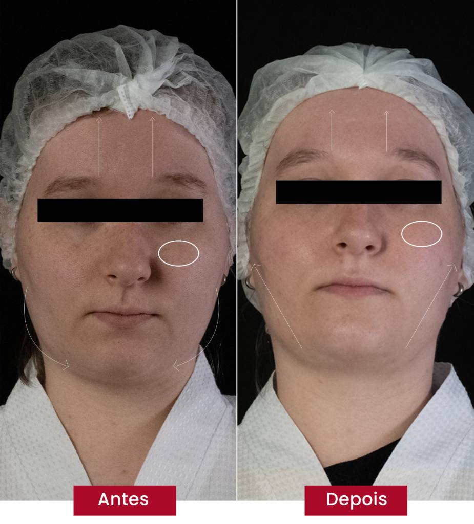 Glass Skin Coreana reduz manchas na pele e causa efeito lifting