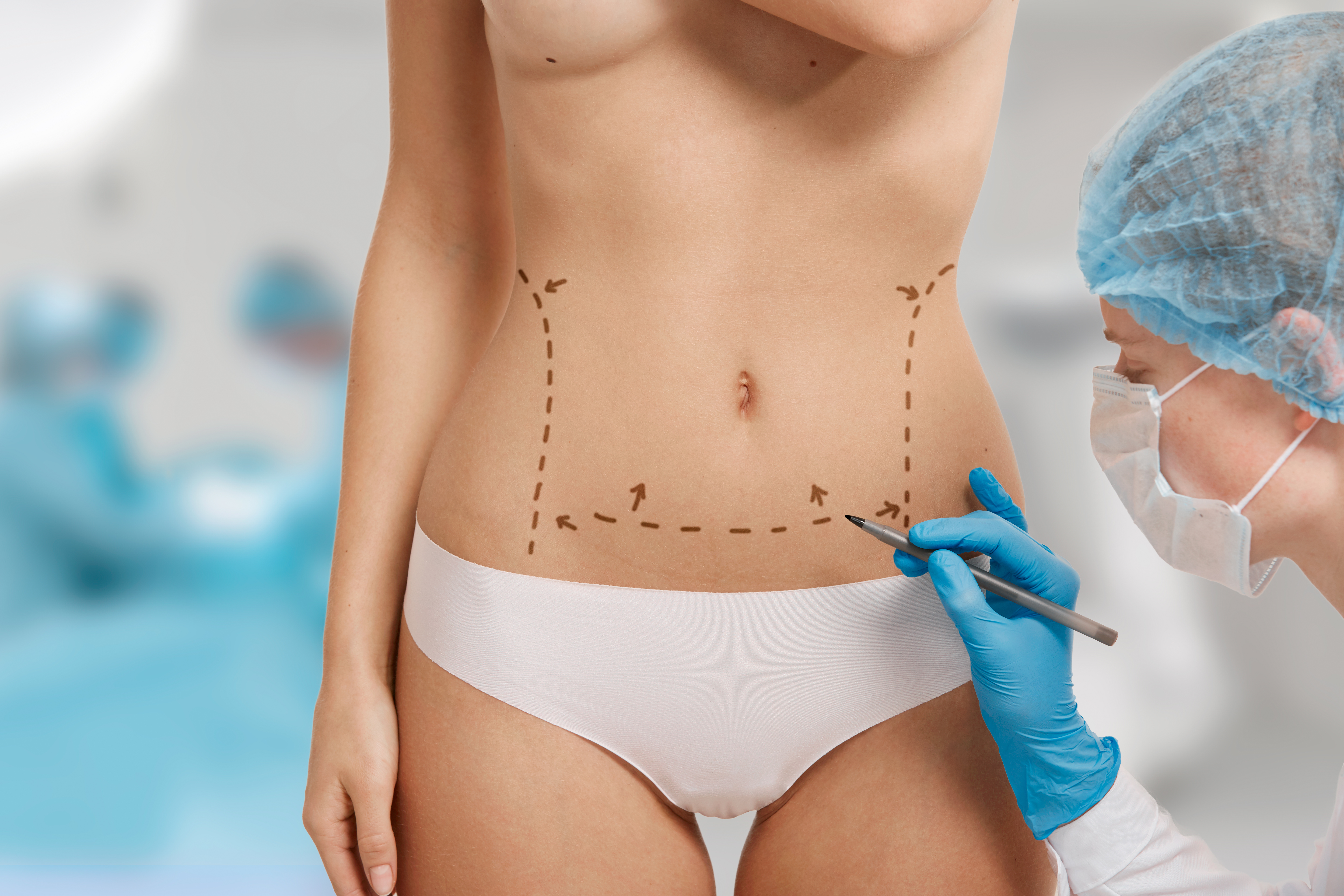 Sinais de que uma barriga passou por uma cirurgia pl&aacute;stica